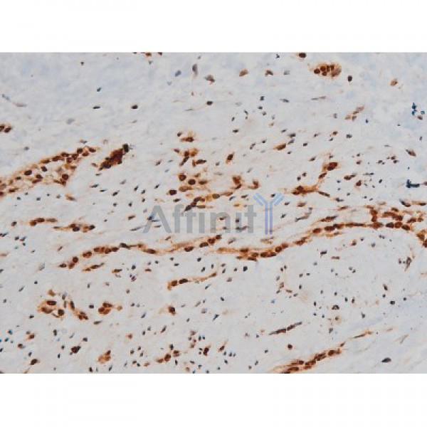 Phospho-Ezrin (Tyr353)[Tyr354] Antibody - AF3173 at 1/200 staining Human bladder cancer tissue sections by IHC-P.